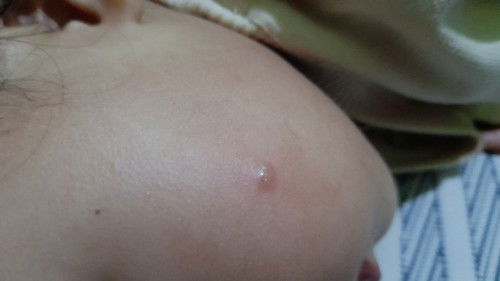 Di gigit nyamuk atau semut atau binatang lainnya ya ini?