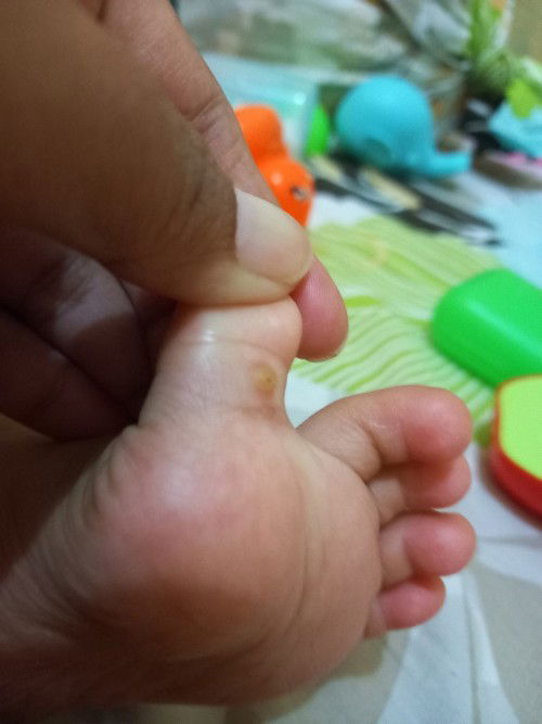 Awalny bintik kecil kaya kutu air gtu kok g ilng .pkai ap y bun