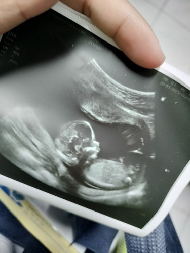 พอจะเห็นเพศน้องไหมคะว่าเพศอะไร
คุณหมอบอกเพศชาย แต่คุณแม่ไม่แน่ใจ คะ