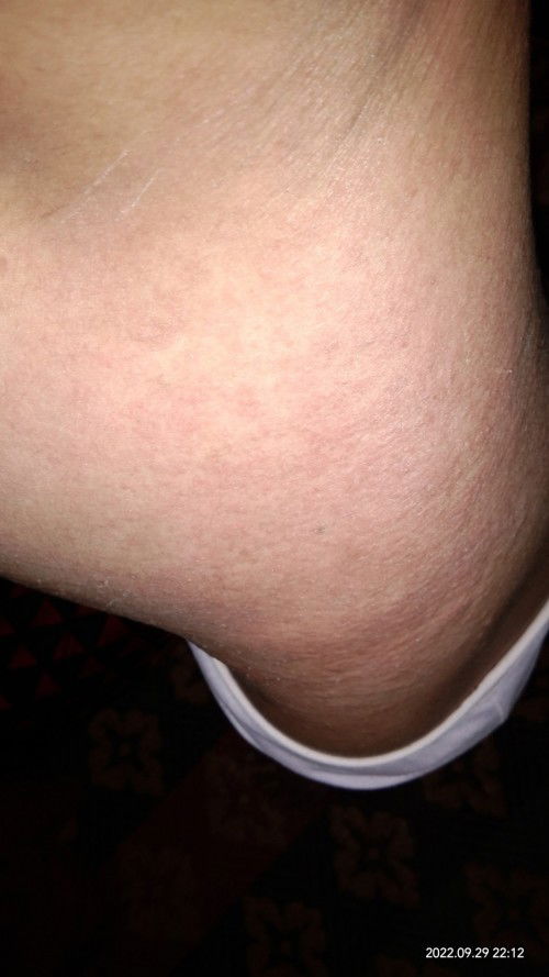 Gatal" gini pas hamil 5 bulan kenapa yaa.. 😫😫 takut janinnya kenapa kenapa..