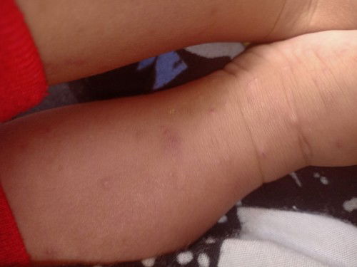 Bayi 7 bln gatal bintik² kecil