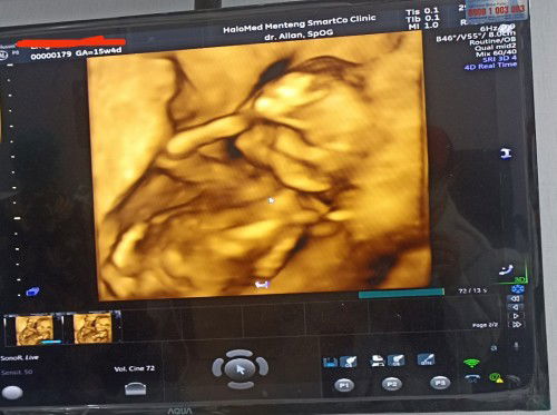 Rekomendasi Klinik USG