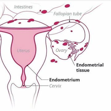 Gejala Endometriosis