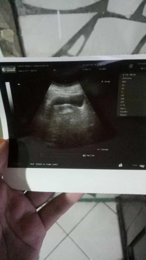 Di tulisan dokter disebut kantung kehamilan belum terlihat, berikut saya lampirkan foto usg nya mom