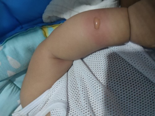 Hello mga mii ano po kayang tawag dito at ano rin po pwede igamot?🥺