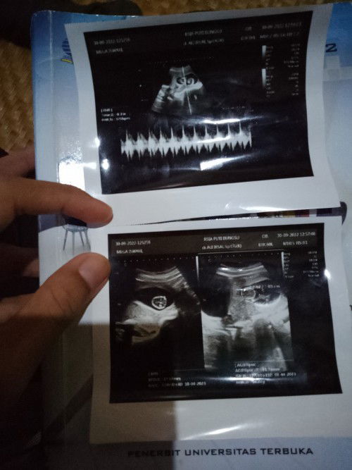 Hamil kembar tapi yang 1 cuma kantung tipis