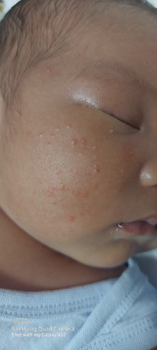 Baby Acne?