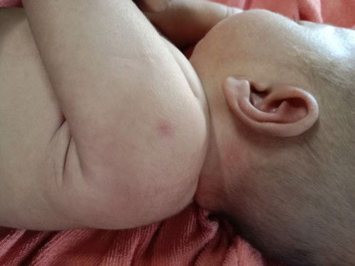 ว่าด้วยเรื่องปลูกฝีดาษ