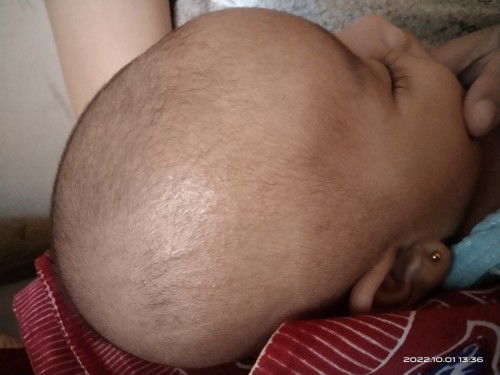 Bruntusan Pada Kepala Baby