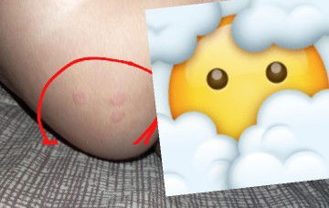 luka pada pantat bayi