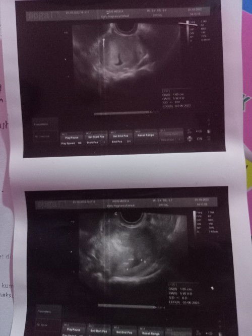 Apakah ada yang sudah USG hamil 5w?