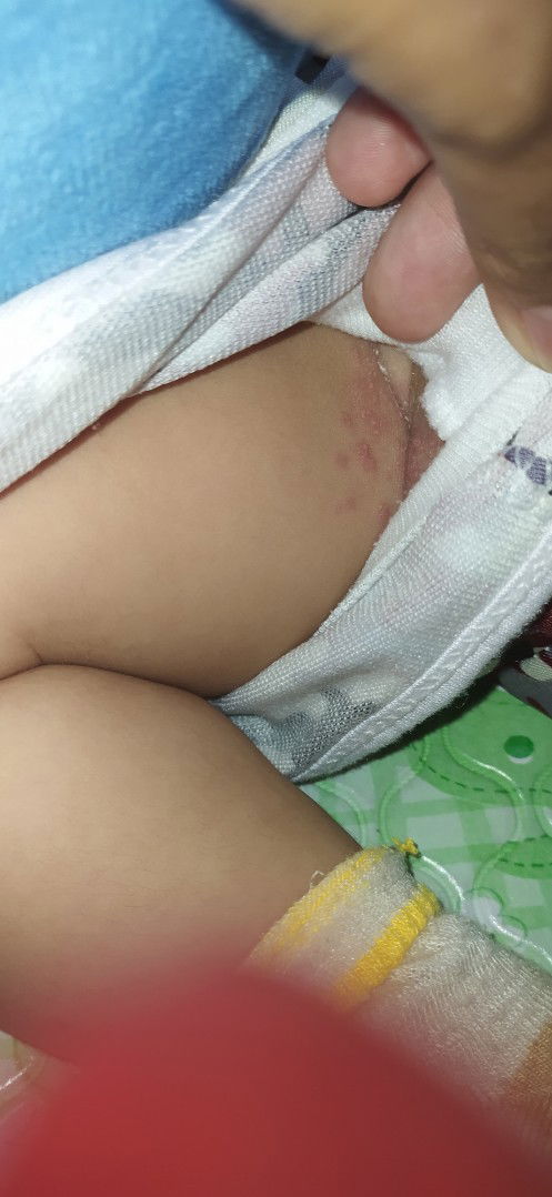 Obat buat ruam popok