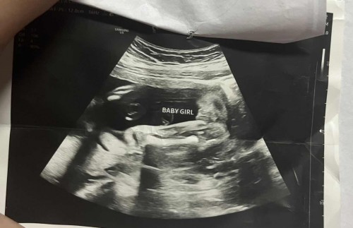 gender ultrasound