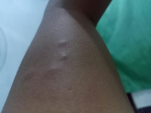 Aku hamil 4 BLN. Tp knp sering gatel KY gini y ap ad yg prnh ngalamin?