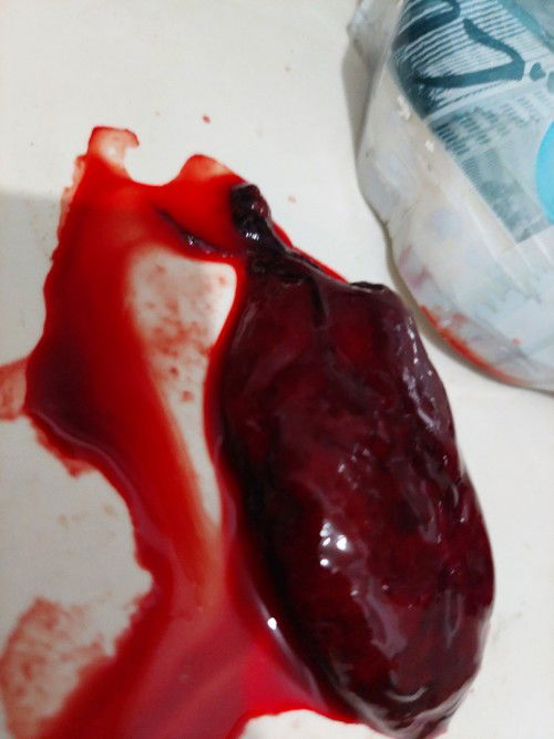 Hamil 9 minggu 5 hari, riwayat abbortus 2x,Tanpa nyeri perut,mendadak pipis keluar jaringan daging