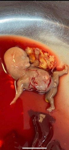 ทารกเสียชีวิตในครรภ์