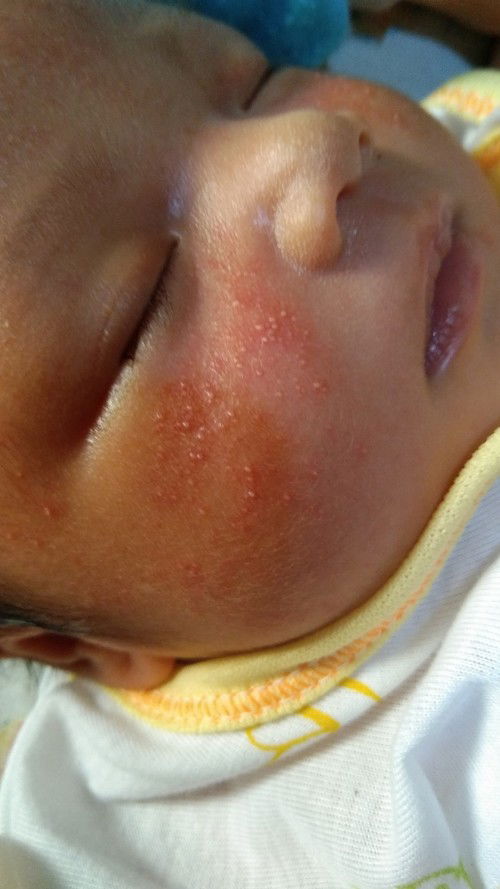 Cara mengatasi bruntusan di pipi?