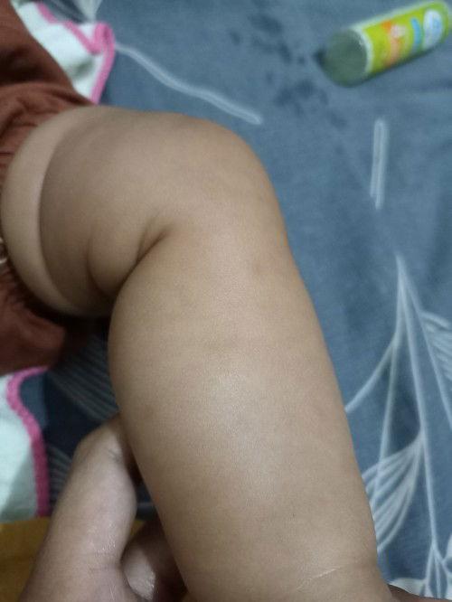 Bekas gigitan nyamuk hitam