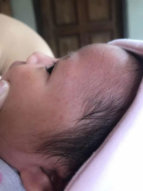 ตุ่มแดงๆแบบนี้เกิดจากอะไร