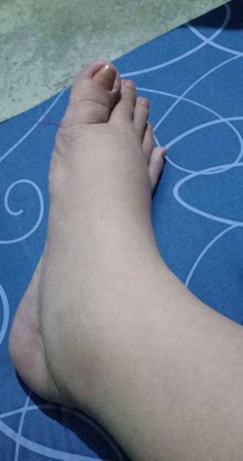 Mga momsh! Ano ba pwede Gawin dine sa pamamanas? 37weeks n ko.. okay naman po BP ko nung mgpacheckup