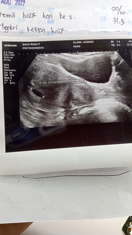 Bun mau tnya kalo pas usg 6w cuma keliatan kantong rahim itu normal ga si?