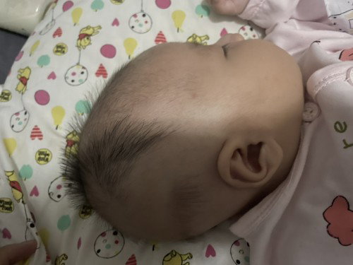 ลูกหัวแบนแก้ยังไง