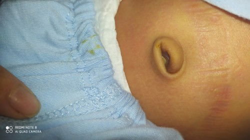 Các m cho e hỏi là con e dc 15 ngày rồi mà rốn vẫn thế này liệu có bị nhiễm trùng không ạ .