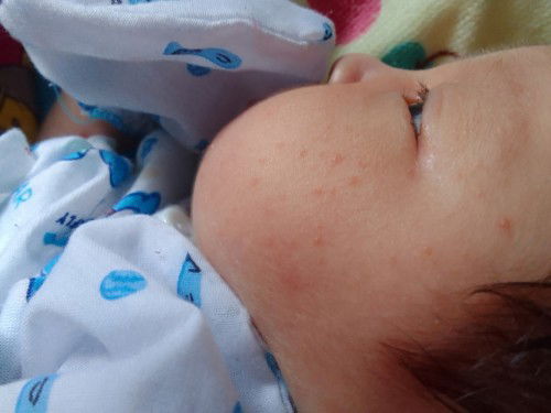 จุดแดงๆคืออะไร