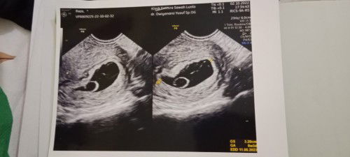 Kehamilan 8week lebih tp janin masih belum terlihat