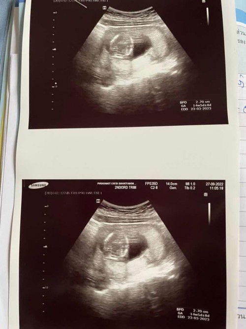 วันนี้มาแชร์ประสบการณ์ฝากครรภ์ฟรีกับโรงพยาบาลรัฐค่ะ