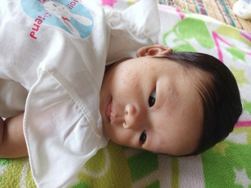 ลูกเป็นผื่นที่หน้า