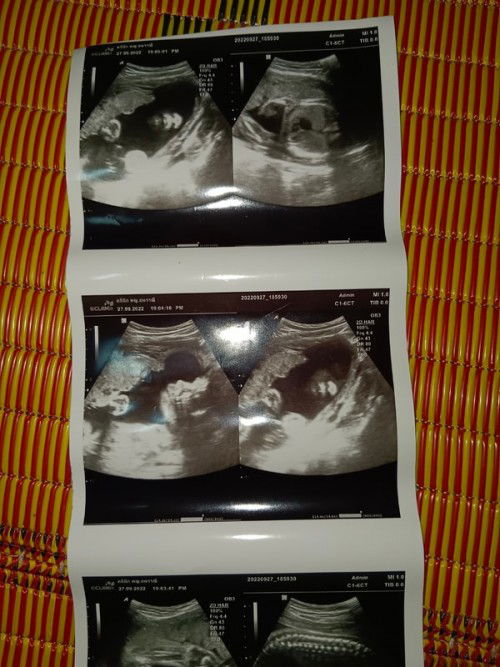 ตั้งครรภ์จ28/สัปดาห์