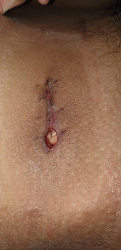 bumuka ang tahi ng appendectomy ko
