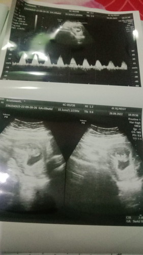 Usg 9 wk 6 hari