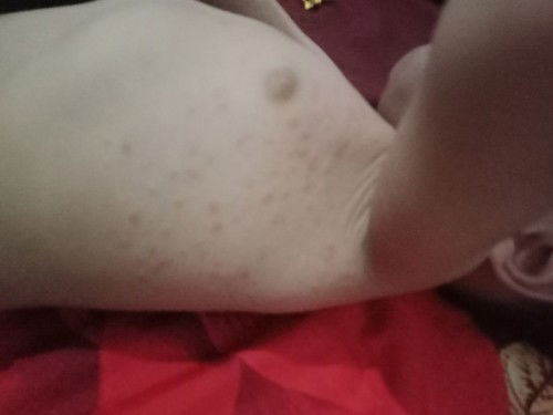 Biang keringat atau alergi