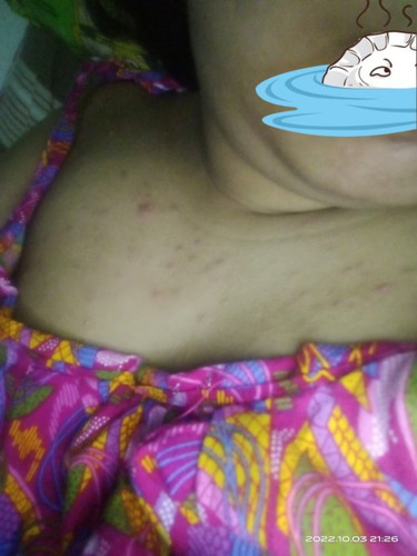 Aku mau tanya dong bunda² kenapa yaa di dada aku ko seperti ini hadehh solusinya pakai apa yaa😭