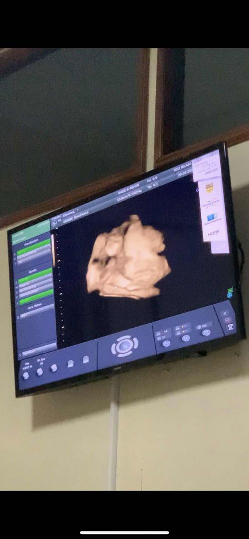 34 Week HPL tensi darah tinggi