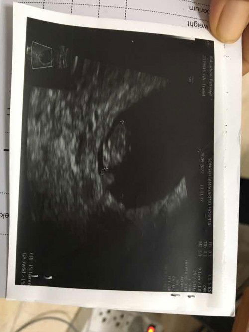 ลูกในท้องตัวเล็กแม่ๆคนไหนเคยเจอเหตุการณ์แบบนี้บ้างค่ะ