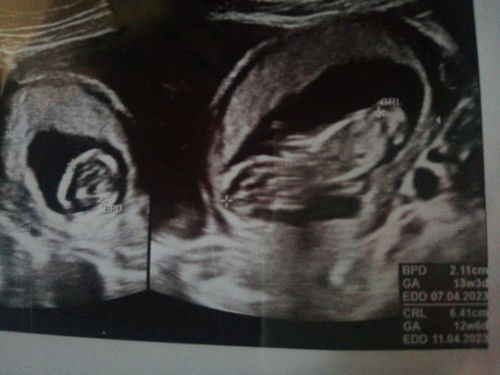 CRL/Ukuran janin lebih kecil dari usia kandungan