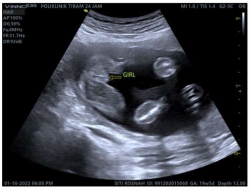 Scan gender