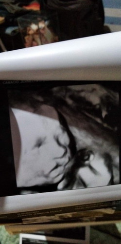 Sino po nakaranas ng ganito sa baby nila ? Unilateral Cleft lip po daw sabi ni Ob ko. Tama po ba to?