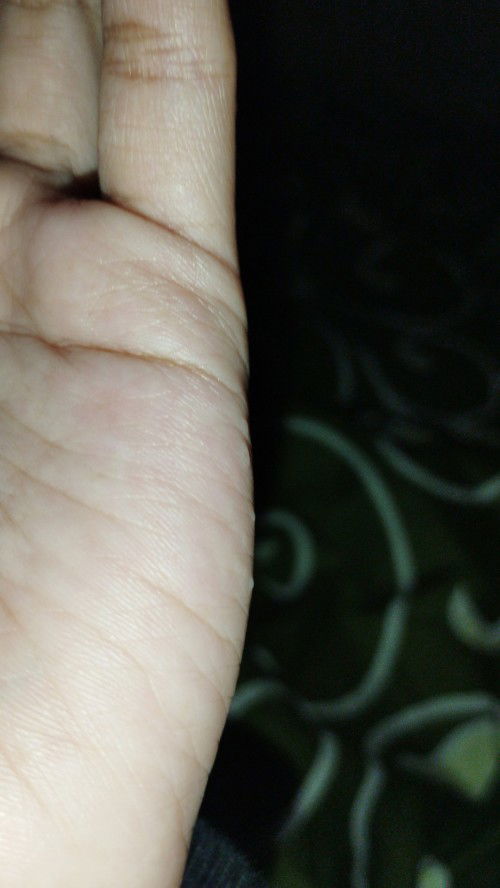 Tangan gatal" dan bintik" putih