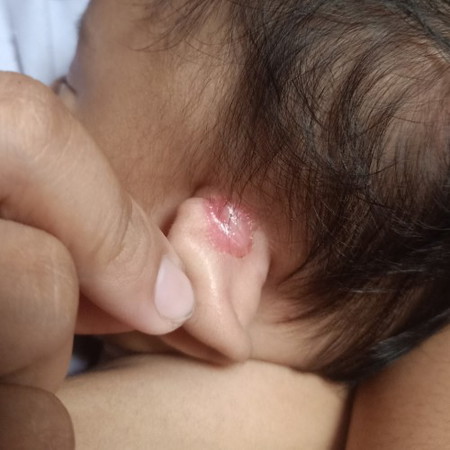 Rashes sa tenga