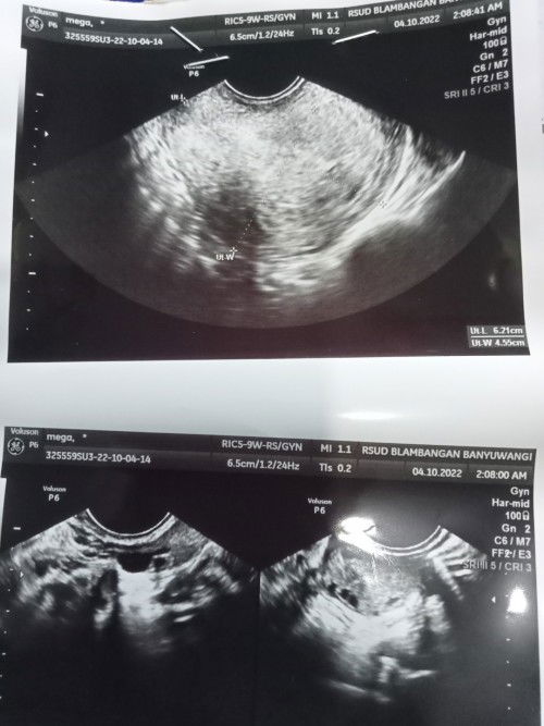 Minggu ke5 sudah ada kantong janin tpi Minggu ke 6/7 kantong janin TDK terlihat