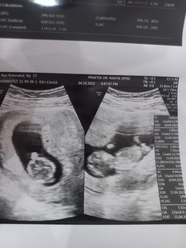Mom, hari ini aku periksa kandungan usia 12 week 6hari. Hasil usgnya seperti ini. Ada yg sama g mom?