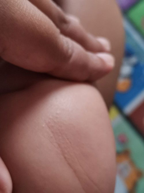 Biji dekat lutut baby