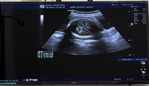 แม่ๆท่านไหนเคยu/sเจอถุงน้ำในสมองลูกบ้างคะ