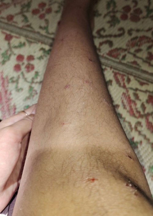 Gatal bentol digaruk luka lalu jadi koreng