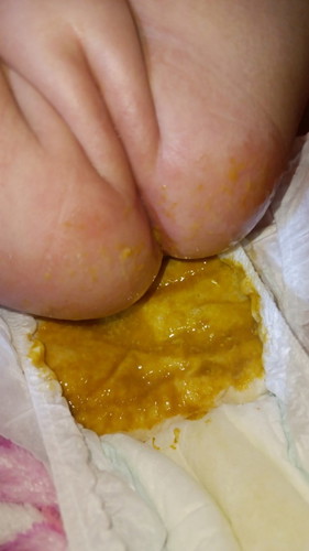 Yellow Watery Poop