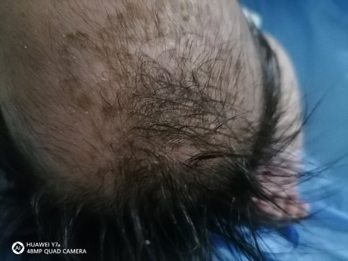 Balakubak sa ulo ni baby.. Ano po kaya ito?